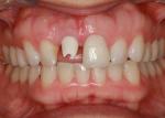 Implant after integration.
