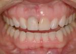 Right central presented with root resorption.