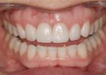 Implant crown, adjacent central veneer and lateral veneers completed with CEREC technology (IPS Empress Multi B1).
