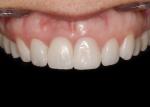 Excellent soft tissue response.