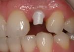 Abutment prepared for ideal soft tissue support.