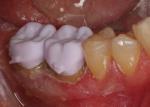 Milled intermediate phase lithium disilicate crowns seated to evaluate margins, interproximal contacts, and occlusion. 