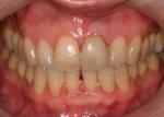 Pam’s left central was diagnosed with a root fracture. She wanted to preserve the natural look and chose implant treatment.