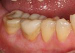 Pre treatment view of worn crowns and posterior bite collapse. 