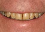 This client is a successful CEO and even with his success, felt his smile was holding him back from being his best.  