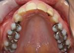 Client desired to even color and alignment of teeth in smile zone.  