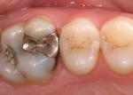 The CEREC technology provides an ideal way to precisely restore teeth with restorations that fit like gold. 