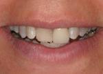 Two teeth can make all the difference. 