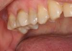 Prior to bite registration, upper crown cusps are recontoured to realign molar occlusal plane. 