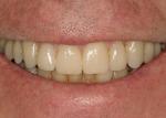 Completed CEREC IPS Empress Multi veneers.