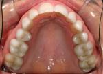 Completed CEREC restorative care.