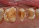 Preparations following ceramic removal.  