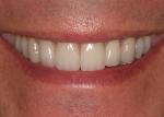  The CEREC hardware and software has the tools to design and produce restorations that rival high-end aesthetics. 