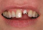Implant placement with zirconium abutment. Note excellent tissue health. 