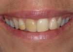 Pretreatment condition.