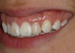 Composite on pegged lateral had discolored, causing the patient to desire a long-term aesthetic solution. 
