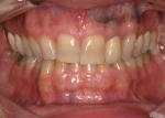 My primary case objectives:  Cant correction, thin centrals, and widen buccal corridors.