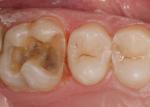 Patients love the conservative approach and completing the treatment in one appointment. 