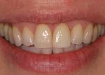The final restoration was designed with CEREC 3D technology and milled from an IPS Empress Multi A1 block.  