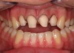 Central and lateral incisors are prepared to retrocline final restorations and create ideal interproximal papillae architecture.