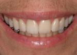 Final veneer restorations were fabricated with CEREC technology using the IPS Empress CAD 100 block series. 