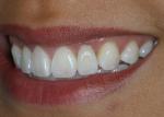 Following whiting procedure, CEREC IPS Empress veneers placed on laterals.