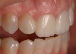 Two teeth can make all the difference