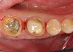 Preparations will need soft tissue alteration to establish clean and crisp margin exposure. 