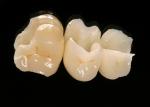  The molar is IPS Empress Multi A3  and premolars Multi A2 ceramics.   