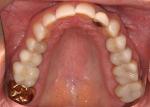 Pretreatment maxillary occlusal view.
