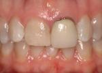 Pretreatment close up. 
