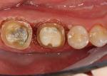 Laser troughing accomplished with Diode Navigator laser exposing clean crisp margins and tissue welding for hemorrhage control. 
