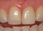 The final implant restoration.  