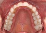 IPS Empress CAD block selection: Molars and Premolars Multi B1, Canines Multi A1, and Incisors B1 with incisal cutback.  