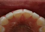 Notice the harmony of #7 & #10 labial surface profile with adjacent centrals and canines. 