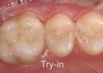 It is customary to try-in ceramics prior to bonding. Note the accuracy of the dry-fit restoration.  