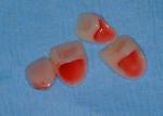 Restorations were bonded with Excite and Variolink Veneer +2 resin. 