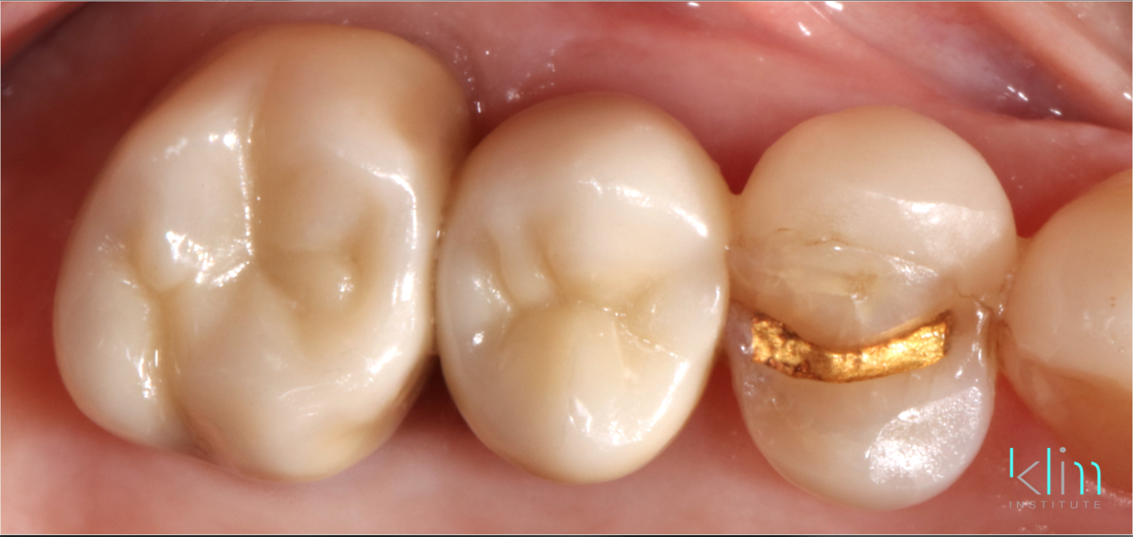 Klim Institute zirconia restorations