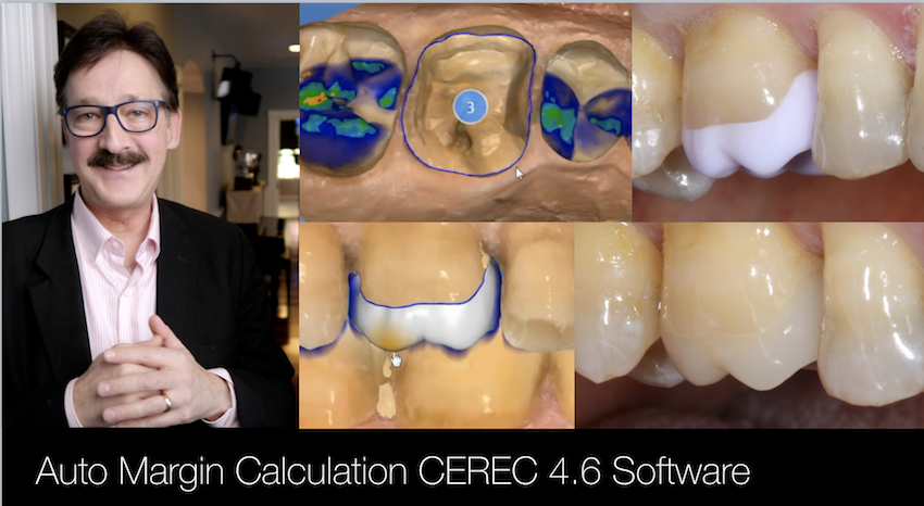 http://www.cadstar.org/video/cerec-margin-auto-calculation