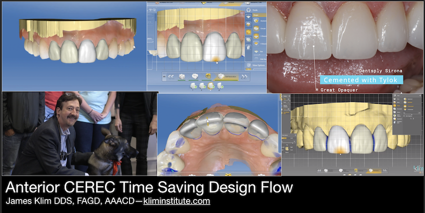 Part one video in BioJaw anterior design series. The way I save time in my anterior design theater is to go into the case preplanned with a wax-up which I now do in inLab, print the model and use the wax-up as a reduction guide and basis for making provis