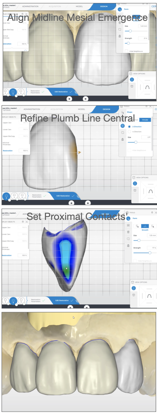 Designing the Midline in the CEREC Software