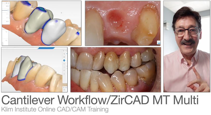 CEREC Cantilever Training