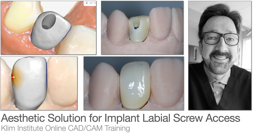 Implant restoration