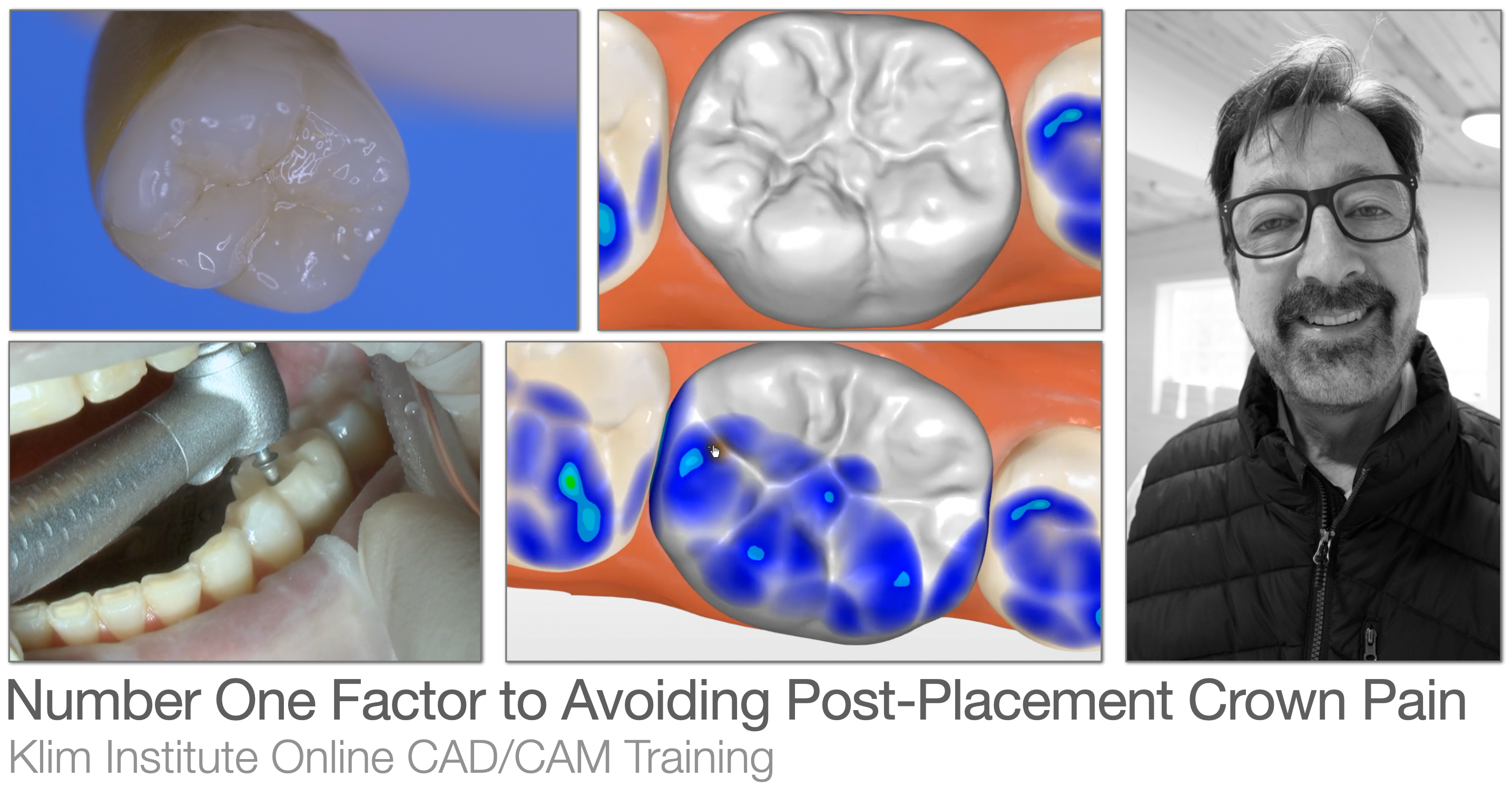 CEREC Occlusion