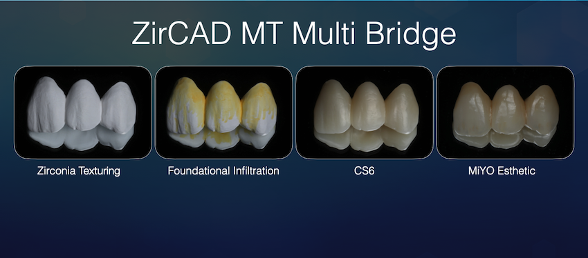 Zirconia Bridge