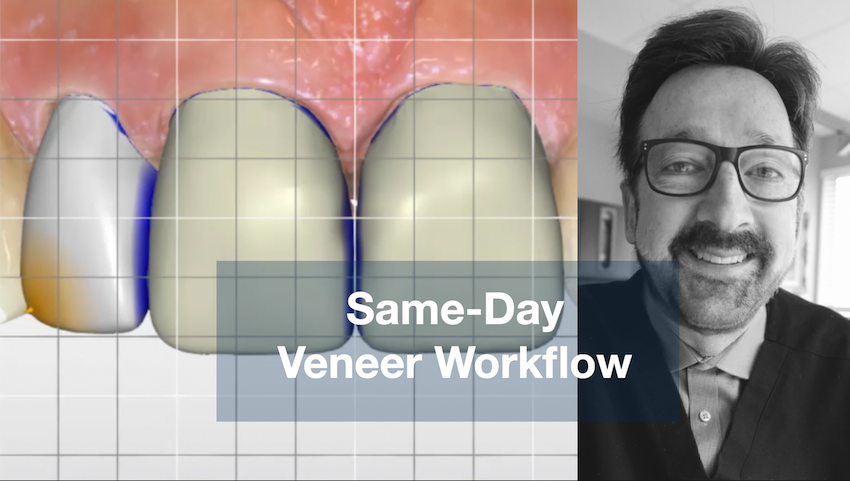 Digital Veneers