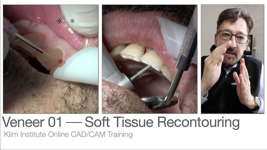 Laser Recontouring