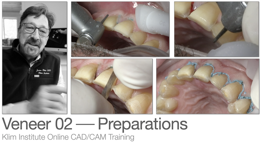 dental veneer preparation