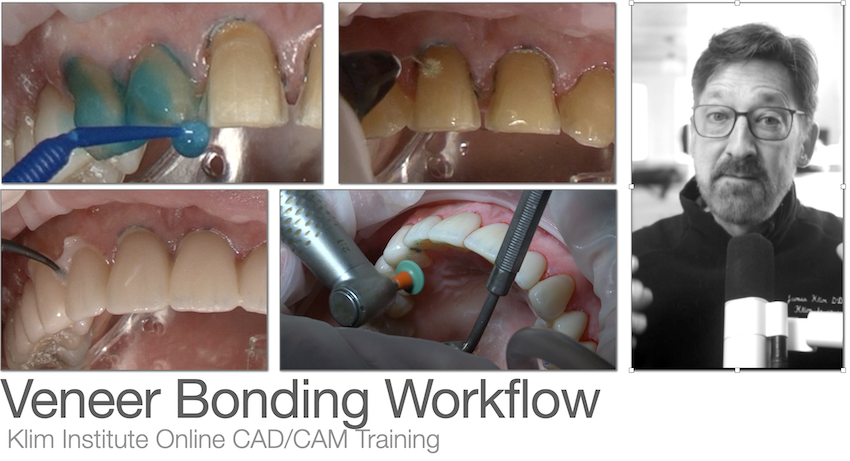 Veneer Bonding Workflow