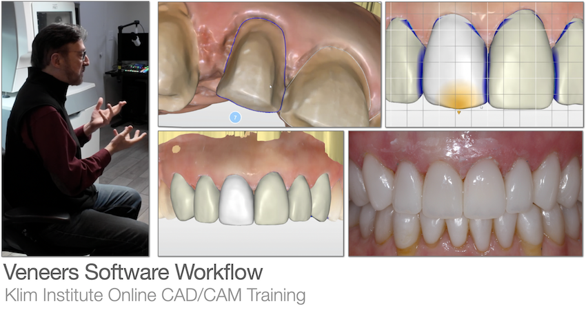 CEREC Veneers Software Workflow